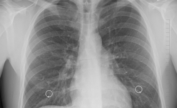 Jihomoravští plicní lékaři odhalili v kraji 16 nemocných 